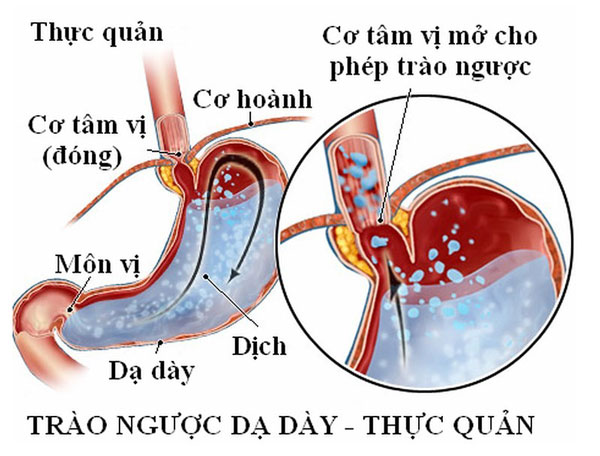Ảnh 2 của Trào ngược dạ dày thực quản